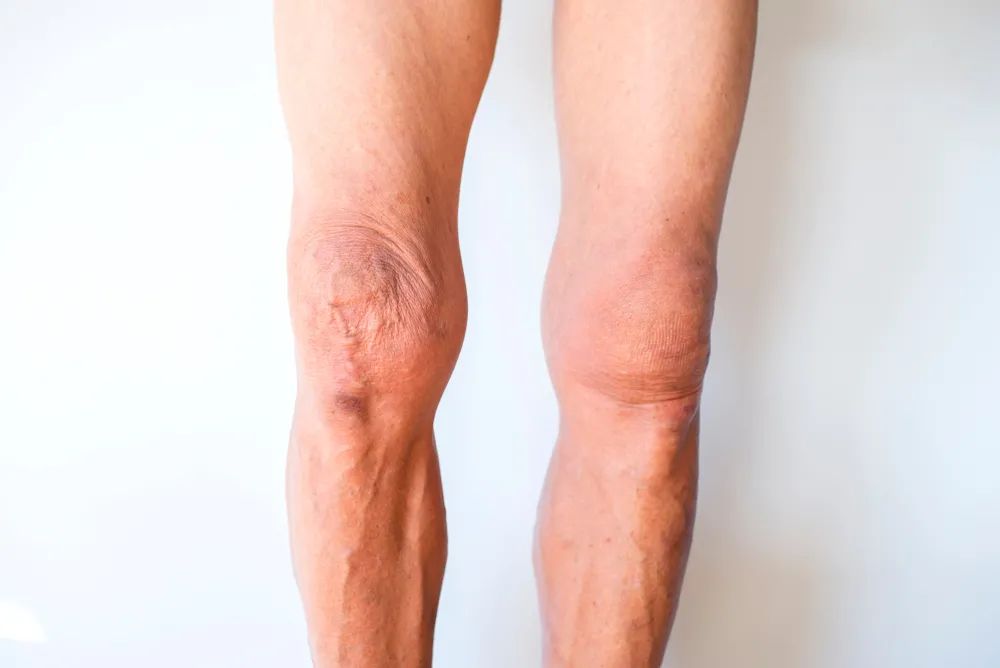 膝关节咔咔响膝盖弹响怎么回事？